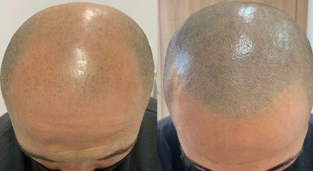 Micropigmentación Capilar densidad de pelo
