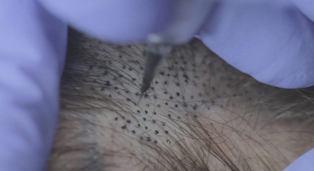 Micropigmentación Capilar sesiones