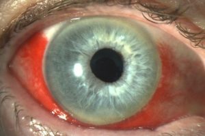 Ojos tatuados Peligros