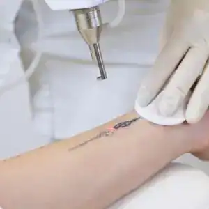 Eliminación de tatuajes