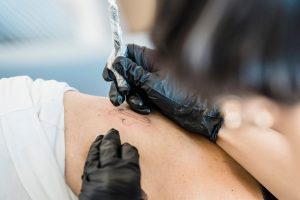 Eliminar tatuajes con laser